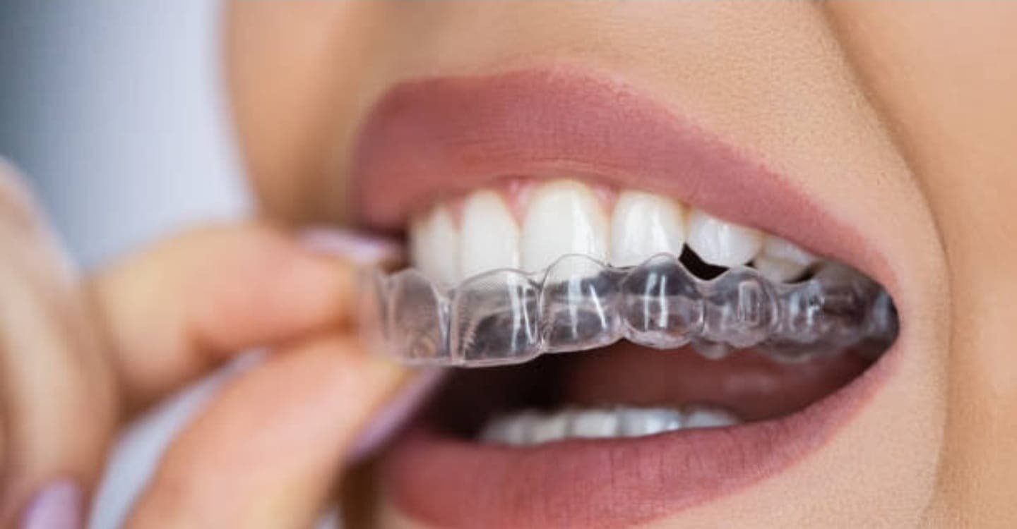 Alinhador transparente sendo encaixado nos dentes