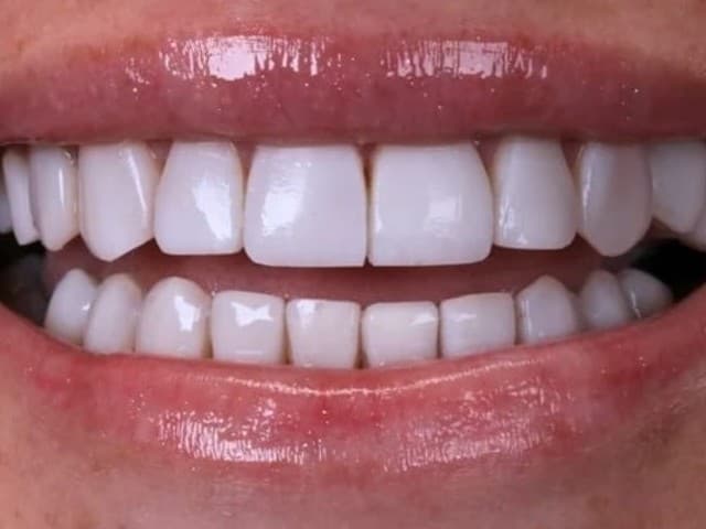 Detalhe dos dentes de paciente da Dra. Fabiana Luchesi depois do tratamento com lentes de contato dental
