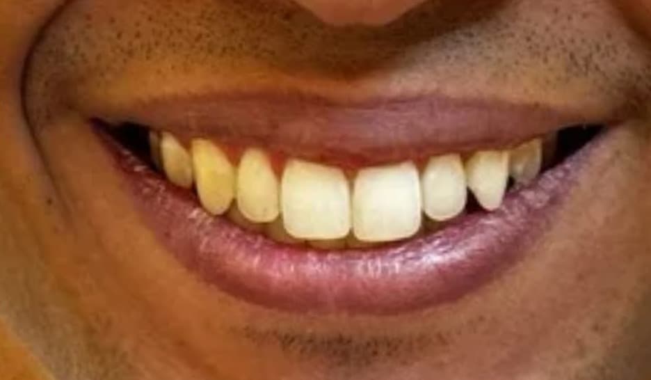 Sorriso do paciente antes do clareamento dental