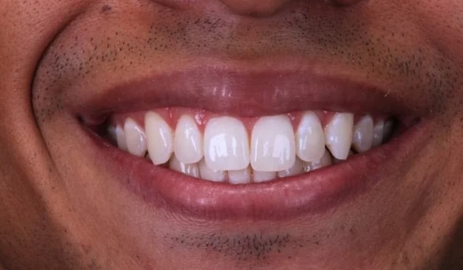 Sorriso do paciente depois do clareamento dental