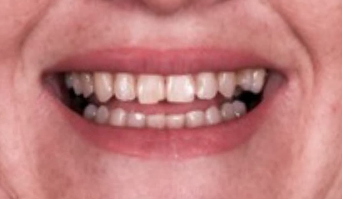 Sorriso da paciente antes do tratamento com facetas e lentes de contato