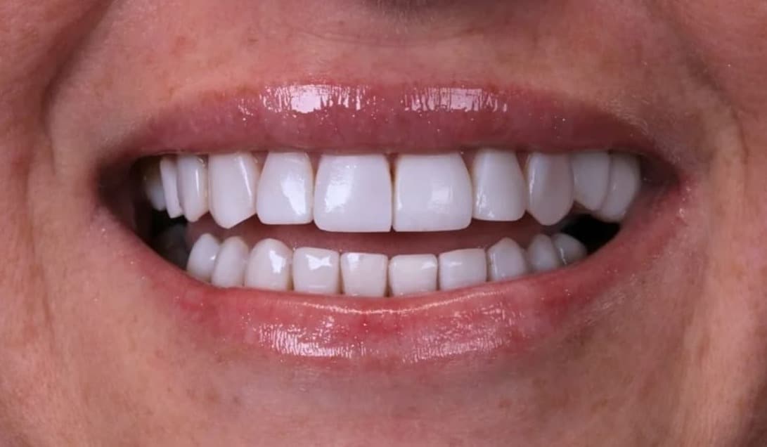 Sorriso da paciente depois do tratamento com facetas e lentes de contato