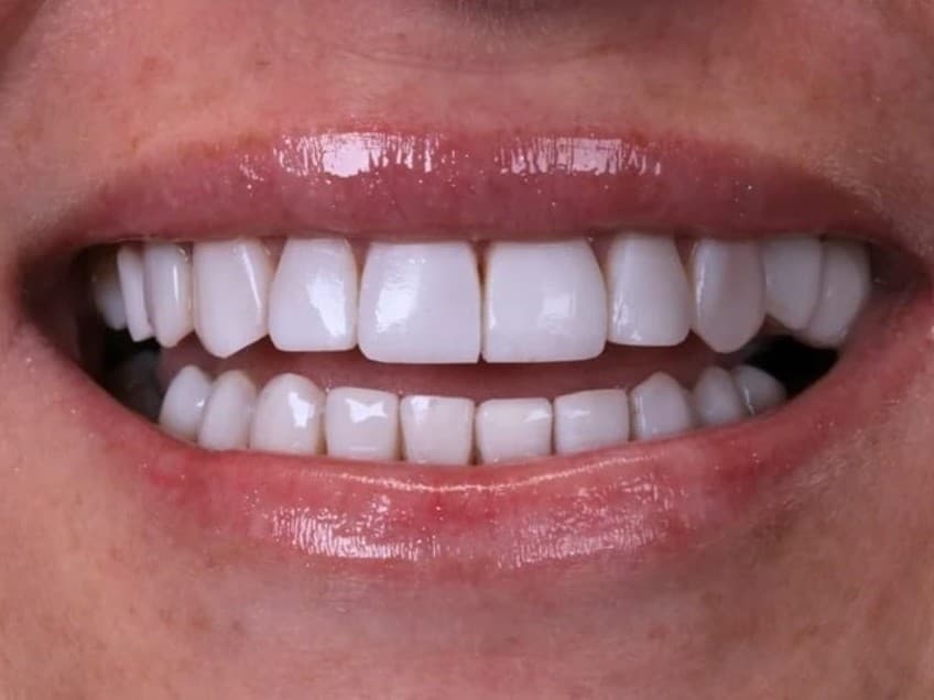 Sorriso de paciente da Dra. Fabiana Luchesi depois do tratamento com facetas